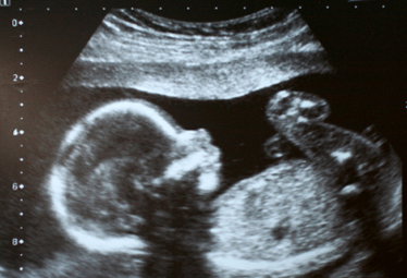Name:  foetus-ultrasound-22weeks.jpg
Views: 229
Size:  66.9 KB